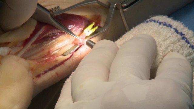 surgery in an operating room/Use of a contact endoscope and record HD
