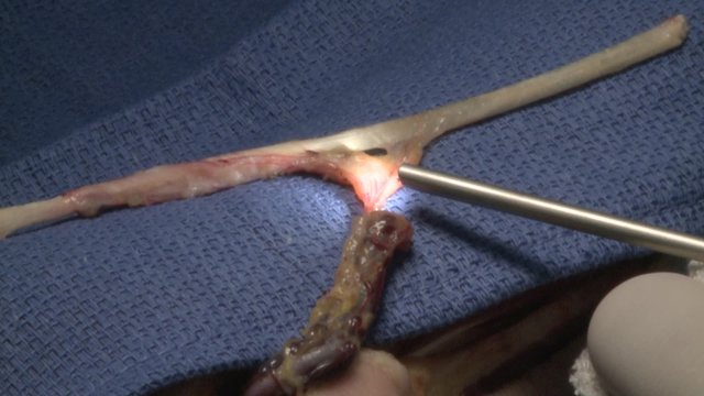 surgery in an operating room/Use of a contact endoscope and record HD

