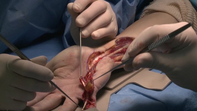 surgery in an operating room/flipping a tendon portion and a flap dermis
