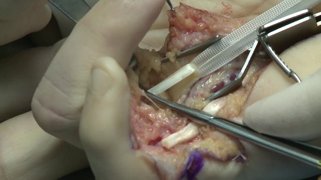 surgery in an operating room/cutting a portion of the annular tendon

