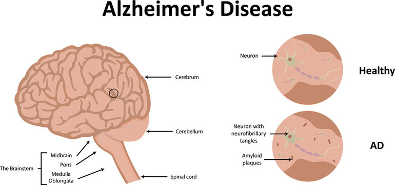 Alzheimer's Disease Illustration