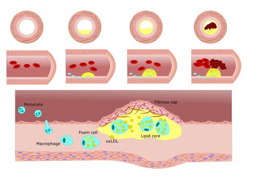 formazione di placca ateromatosa: aterosclerosi