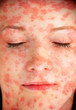 Hautauschlag im Gesicht