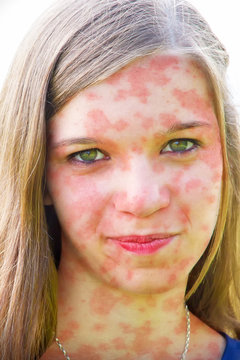 Mädchen mit roten Flecken im Gesicht