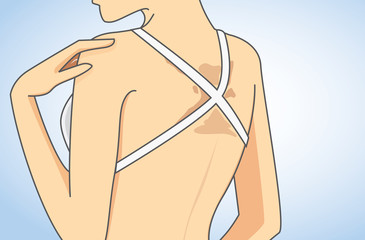 Fototapeta premium Woman wearing bikini has skin discoloration on back in close up illustration