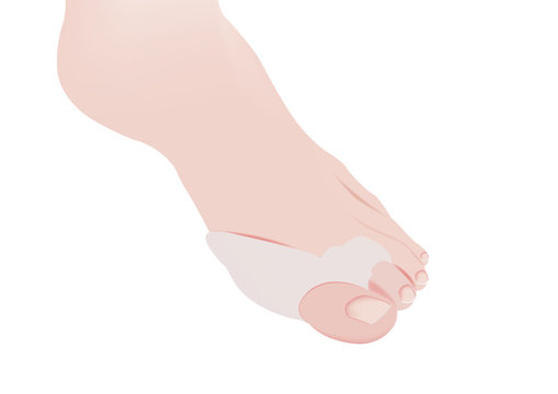 tutore  ortopedico del piede