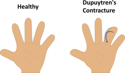 Dupuytren's Contracture Illustration
