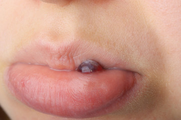 Naklejka premium Blutblase an Unterlippe geschlossener Mund