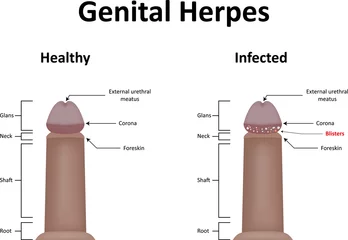 Fotobehang Genital Herpes Illustration © joshya