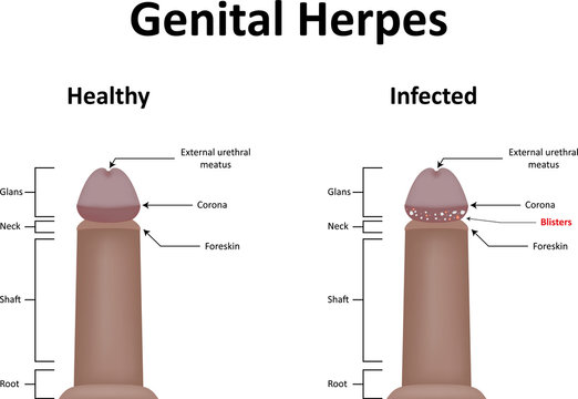Genital Herpes Illustration