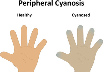 Peripheral Cyanosis