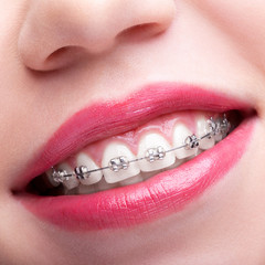 Closeup of woman open smiling mouth with  brackets