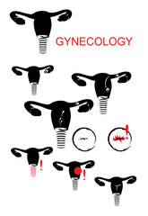 uterus clip-art