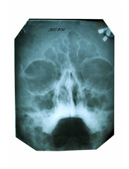 X-ray photography