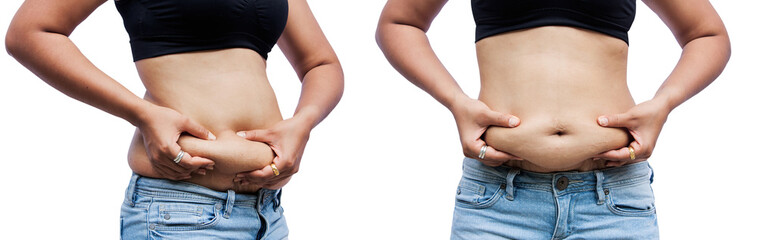 Women body with fat belly and stretch marks