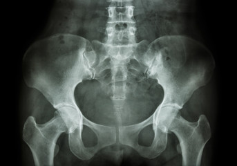 Film X-ray of Pelvis
