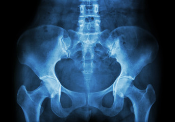 Film X-ray of Pelvis