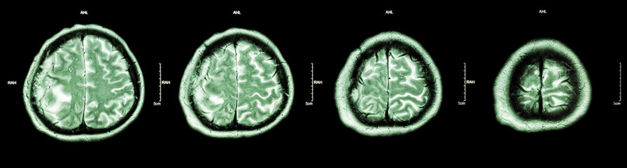 Brain tumor  ( Film CT-scan of brain : show part of brain with tumor )