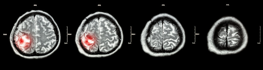 Brain tumor  ( Film CT-scan of brain : show part of brain with tumor ) - obrazy, fototapety, plakaty