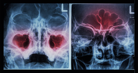 Film X-ray paranasal sinus : show sinusitis at maxillary sinus ( left image ) , frontal sinus ( right image )