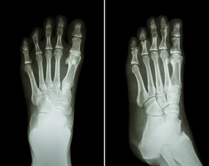 Film x-ray both foot ( 2 position : front view and side view )