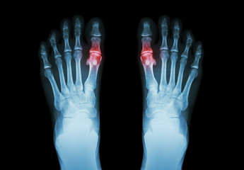 Gout , Rheumatoid arthritis ( Film x-ray both foot and arthritis at first metatarsophalangeal joint...