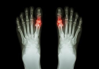 Gout , Rheumatoid arthritis ( Film x-ray both foot and arthritis at first metatarsophalangeal joint...