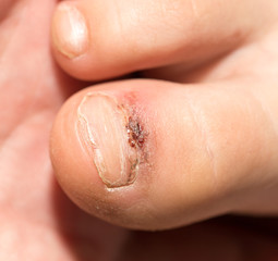 leg wound finger