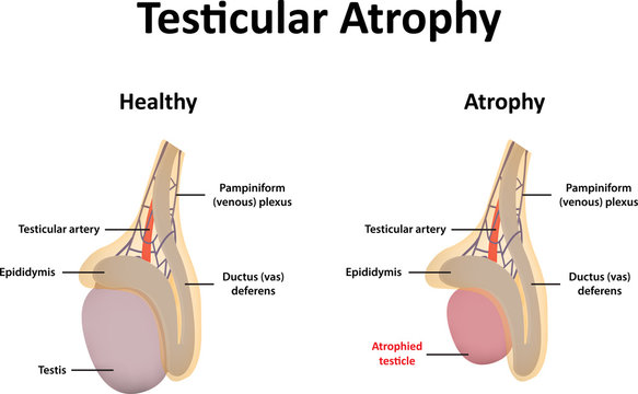 Testicular Atrophy Illustration