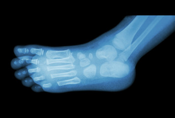 film x-ray of child 's foot ( side view ) ( lateral )