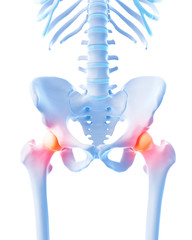 medical 3d illustration of a painful hip - obrazy, fototapety, plakaty