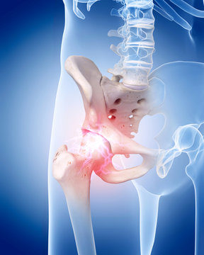 medically accurate illustration of a painful hip joint