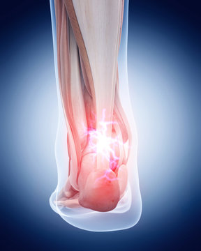 medical 3d illustration of a painful achilles tendon