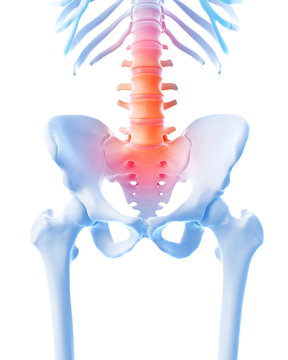 medical 3d illustration of a painful lumbar spine