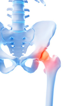 medical 3d illustration of a painful hip