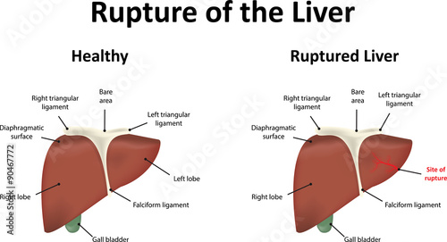 Ruptured Liver Stock Image And Royalty free Vector Files On Fotolia ruptured-liver-stock-image-and-royalty-free-vector-files-on-fotolia