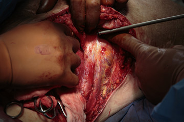 Back muscles during surgery