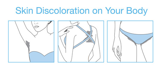 Discoloration of the skin on body part after suntan or outdoor activities