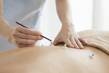 Acupuncturist has placed moxibustion women back