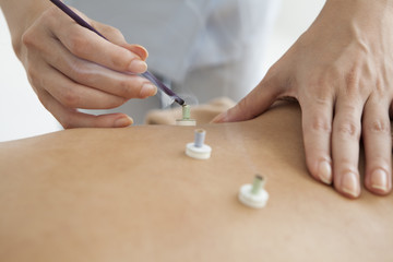 Acupuncturist has placed moxibustion women back