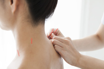 Acupuncturist is treating a woman's shoulder