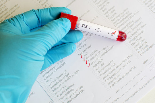 Systemic Lupus Erythematosus (SLE) Positive