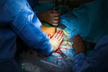 Complex surgery in progress, open bloody cavity