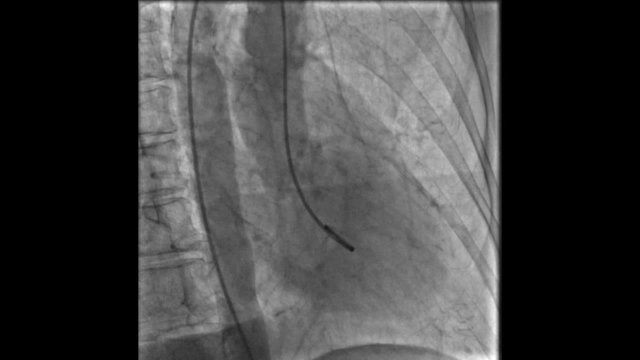 Cardiac Catheterization Scans 3731