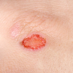 Fototapeta premium Wound