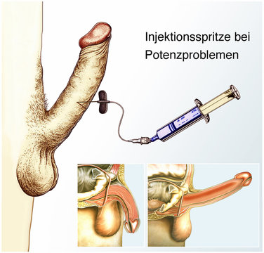 Injektionsspritze bei Potenzproblemen