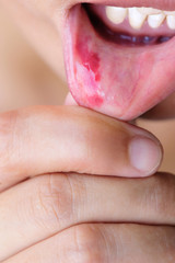 Naklejka premium Woman show her lower lip of the mouth with injury