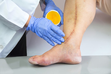 Human leg with postoperative scar of cardiac surgery