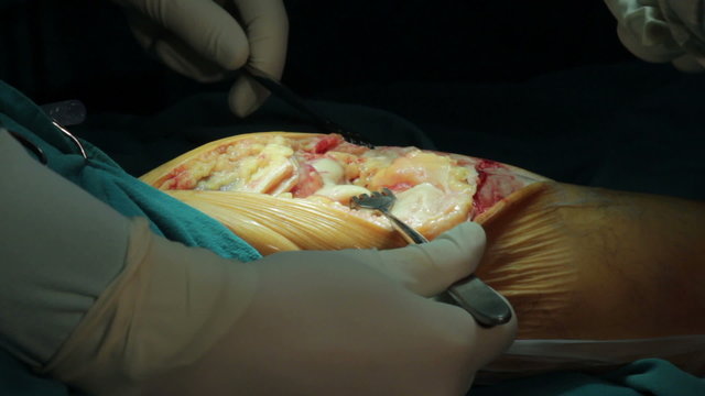 Surgeons removes damaged bone,cartilage from patient's knee,using surgical pliers in operation room,surgical cut,open wound,incision,close up.