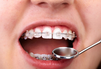 Naklejka premium Teeth with orthodontic brackets.